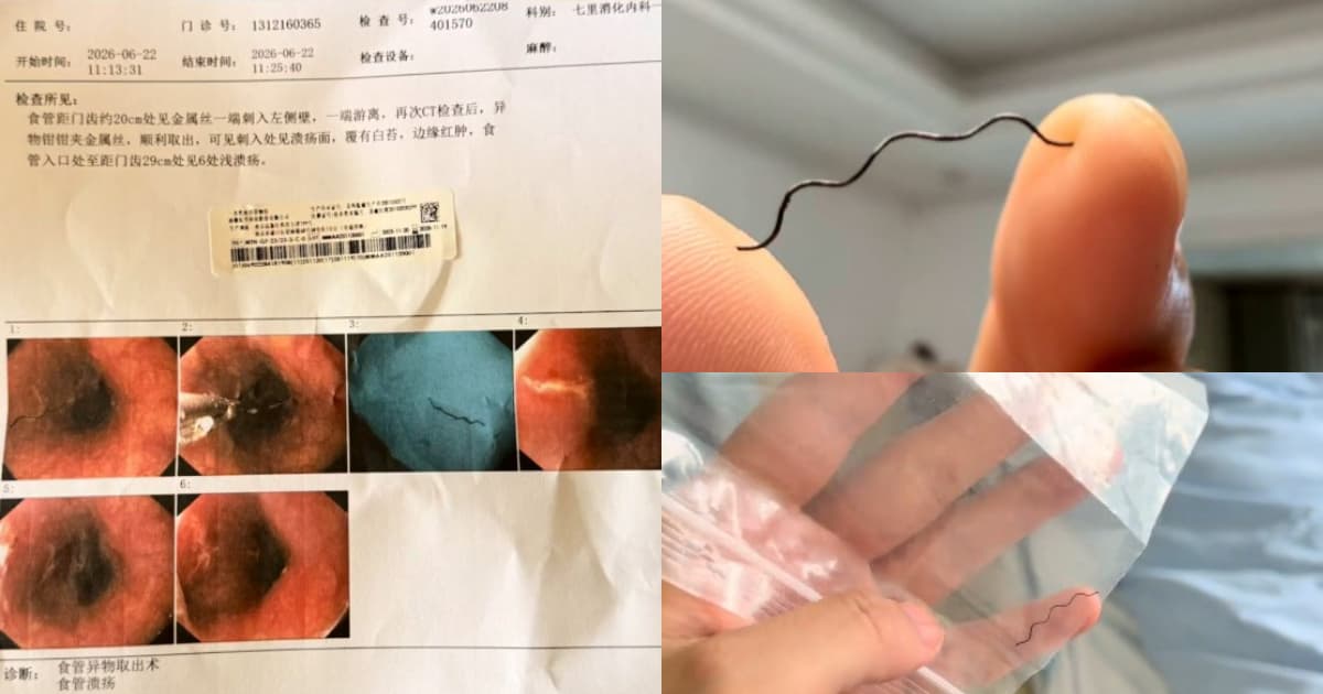 恐怖！女子吃火鍋吞2.2厘米硬鐵絲 喉嚨劃傷（視頻）