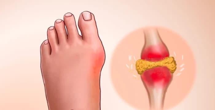 不只靠吃药!痛风的饮食与生活调养全指南